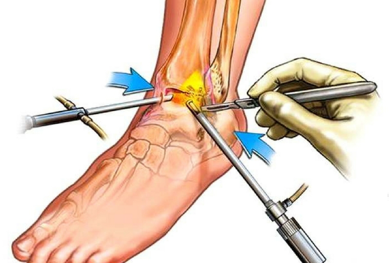 Ankle Arthroscopy Minimally Invasive Surgery Orthopedic Center in Kenya