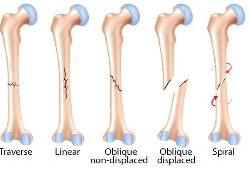 Fracture Care in Kenya | Orthopedic Centre | Orthopedic Surgeon in Kenya