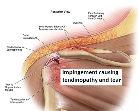 shoulder conditions dr adari orthobridge Institute ...