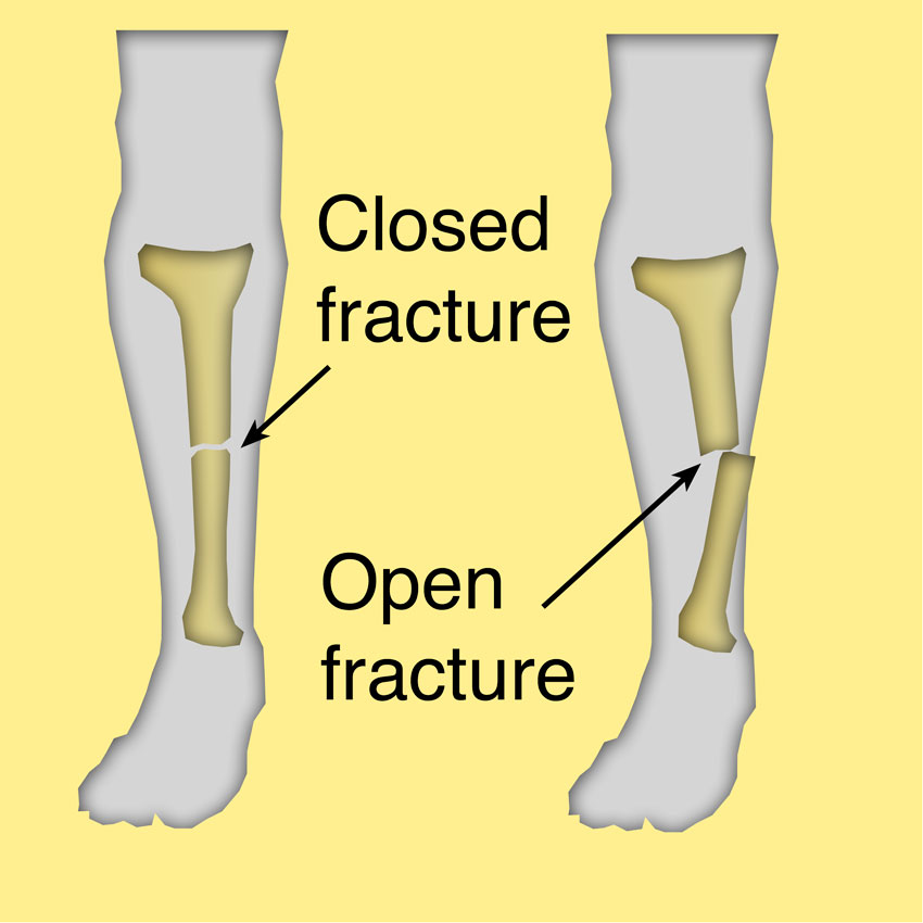 fracture meaning