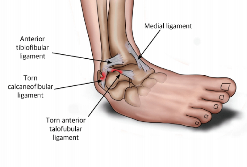pain in ankle and heel