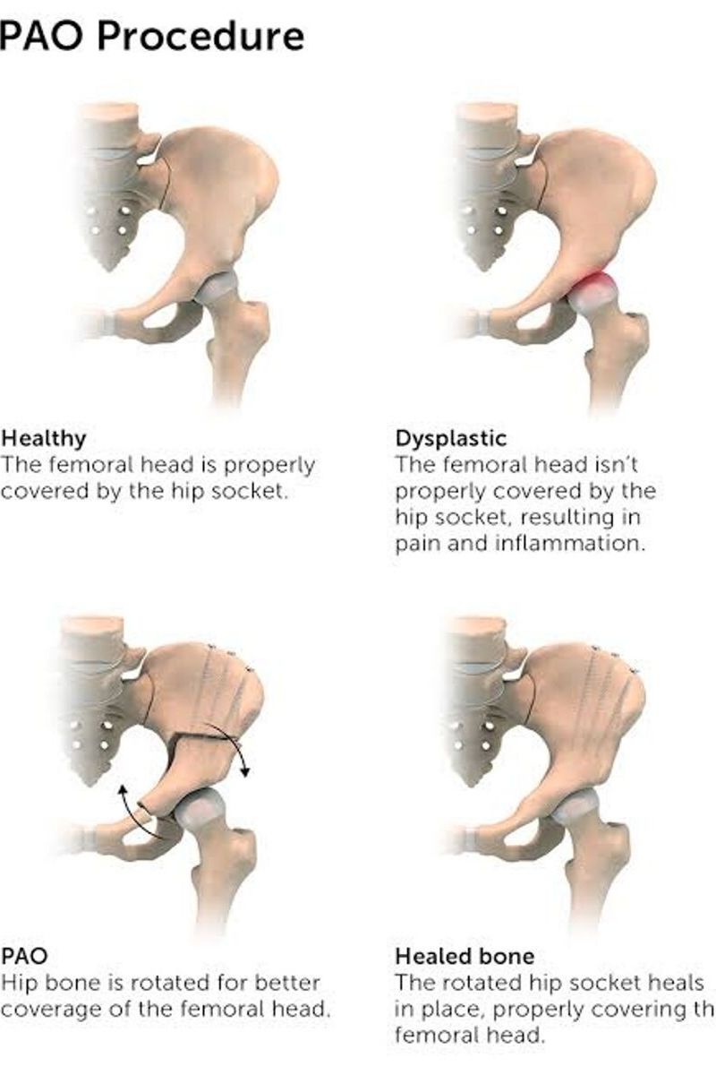 Congenital Hip Dysplasia Treatment in Kenya | Orthopedic Care in Nairobi