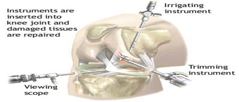 Knee Arthroscopy : Procedure & Benefits | Orthopedic Surgeons